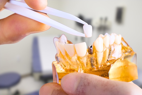 Are Dental Implants Safe?