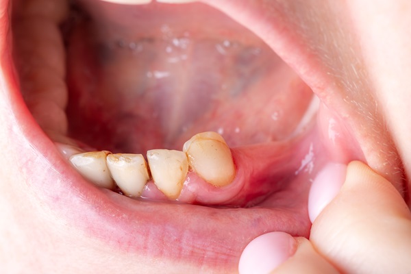 What Treatments Are Involved In Periodontics?